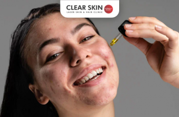 The Ultimate Guide to Fighting Acne with Salicylic Acid The Ultimate Guide to Fighting Acne with Salicylic Acid