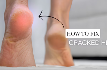 How to Transform Cracked Heels for Sandal Season | Exfoliating Foot Treatment How to Transform Cracked Heels for Sandal Season | Exfoliating Foot Treatment