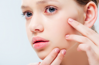 Acne Management: Clinical Strategies for Clearer Skin Acne Management: Clinical Strategies for Clearer Skin